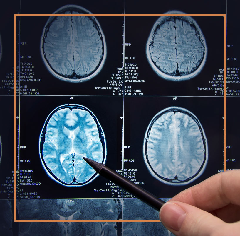 Traumatic Brain Injury Scan – Legal Support from Teale Law Brain scan showing trauma-related damage, used in brain injury legal cases.